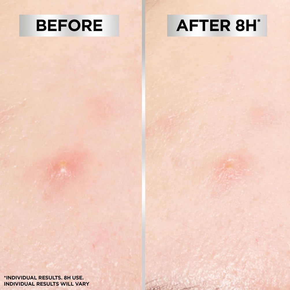 Garnier Blemish Patches, Hydrocolloid patches to reduce the appearance of spots in 8 hrs ,Invisible on all skin tones, All Skin Types, Vegan, 22 Pk